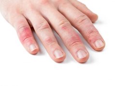 Finger geklemmt in der Autotür: Sofort die Finger kühlen! Finger geklemmt! Man sieht’s sofort. Foto: Adobe / eyetronic