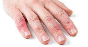 Finger geklemmt in der Autotür: Sofort die Finger kühlen! Finger geklemmt! Man sieht’s sofort. Foto: Adobe / eyetronic