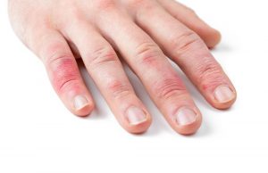 Finger geklemmt in der Autotür: Sofort die Finger kühlen! Finger geklemmt! Man sieht’s sofort. Foto: Adobe / eyetronic