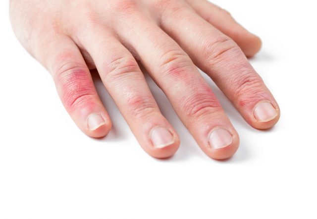 Finger geklemmt! Man sieht’s sofort. Foto: Adobe / eyetronic